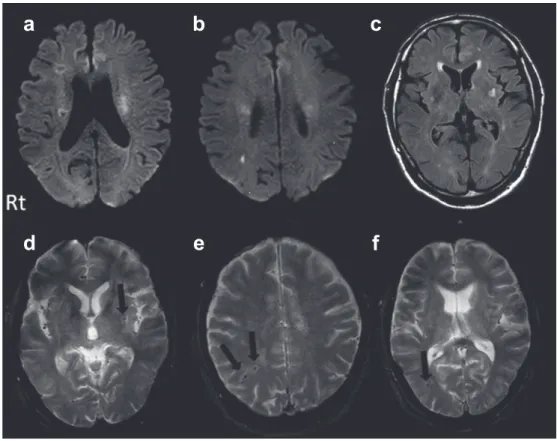 Fig. 2 CT scan of the brain after intravenous rt-PA administration.