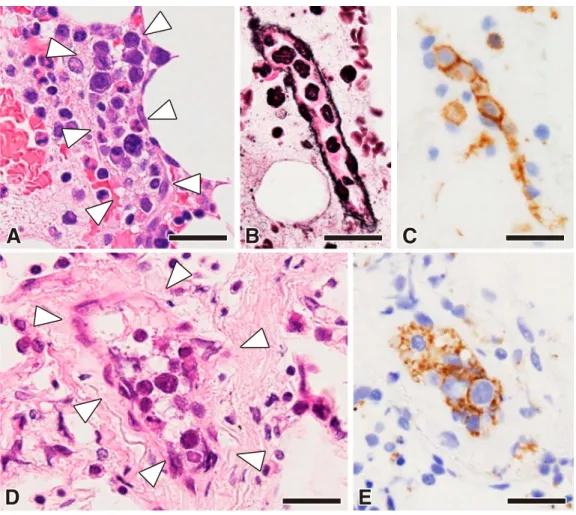 Fig. 3 Histological findings of the second bone marrow puncture and lung biopsy. 