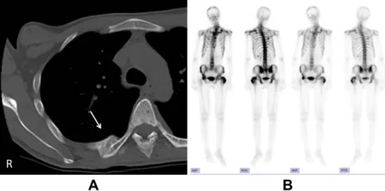 Fig. 1 Chest computed tomographic scans (A) and whole body bone scintigraphy (B) of the patient.