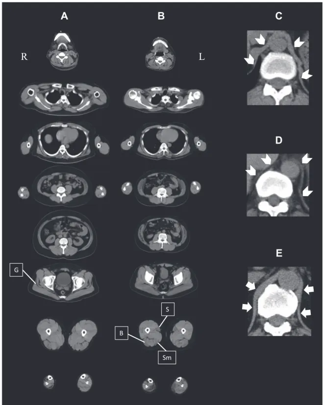 Fig. 2　CT of Case 1 (A, C), Case 2 (B, D), and age-matched control (E). (Case 1: 37-years-old, Case 2: 35-years-old).