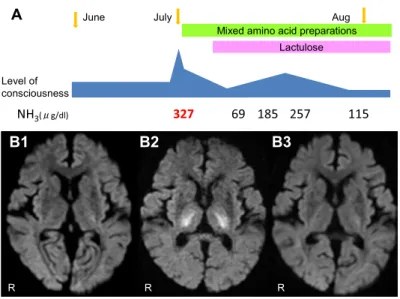 Fig. 3 Electroencephalogram during deep coma.