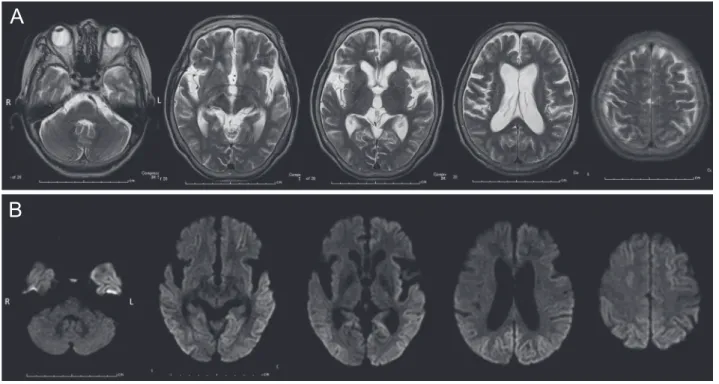 Fig. 2 Brain MRI findings.