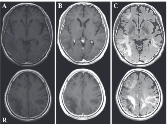 Fig. 1 Brain MRI findings.