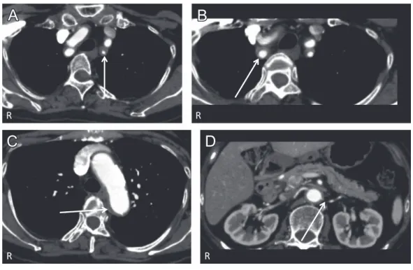 Fig. 2 Enhanced axial CT images.