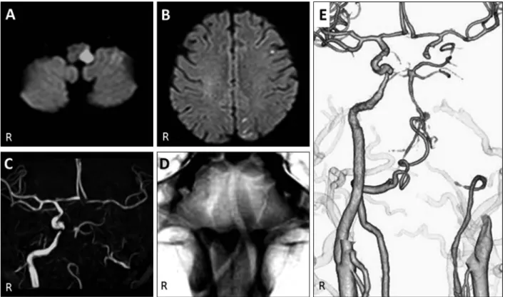 Fig. 2 Noncontrast axial brain CT on Day 5.