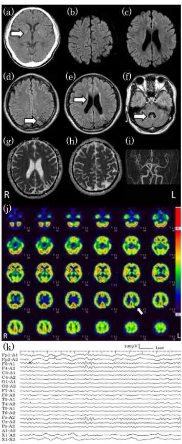 Fig. 1 Head CT, brain MRI, SPECT, and electroencephalogram findings.