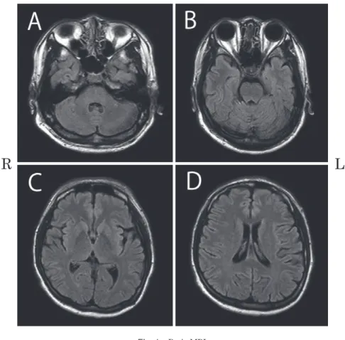 Fig. 1 Brain MRI.