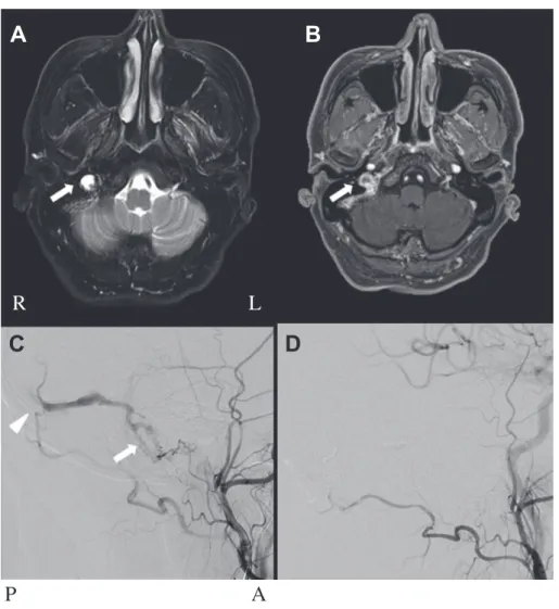 Fig. 2 Brain MRI and External carotid angiography.