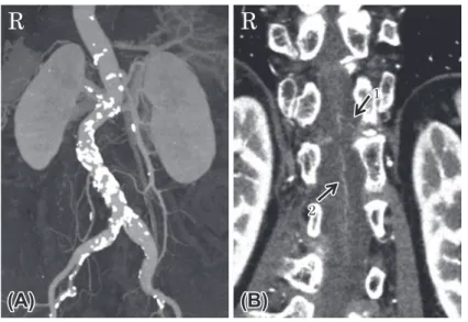 Fig. 2 Contrast CT of the spine.