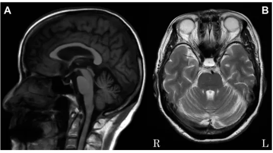 Fig. 2  99m Tc-ECD brain SPECT (e-ZIS) images.