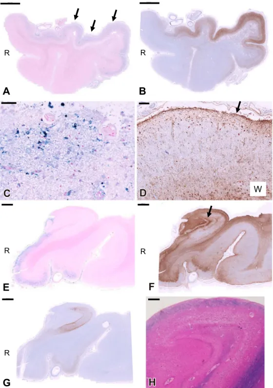 Fig. 6 Microscopic findings of the temporal lobe.