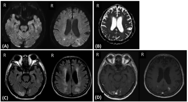 Fig. 1 Brain MRI at 7 days after admission.