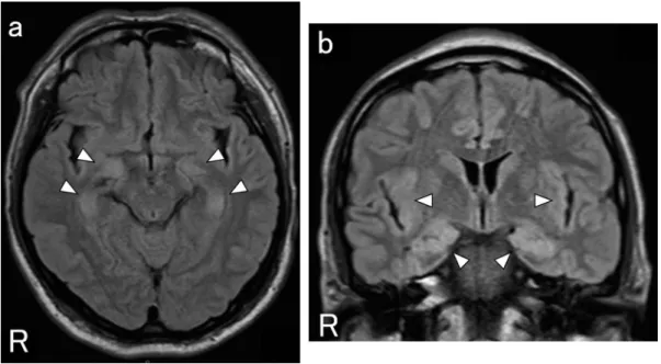Fig. 2 Electroencephalogram (EEG) on day 13.
