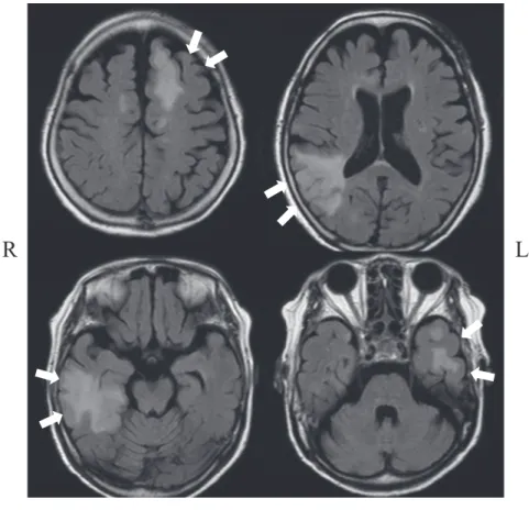 Fig. 2 Thoracic CT image and histological findings of thymoma.