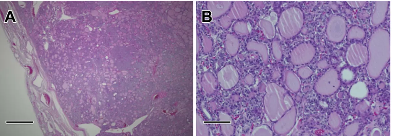 Fig. 3 A histopathological examination of the thyroid biopsy specimen.