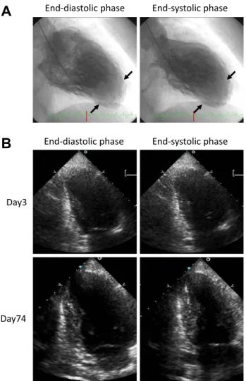 Fig. 4 Left ventricular apical akinesis.