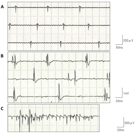 Fig. 2　Needle electromyography.