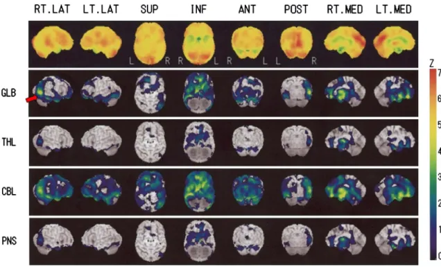 Fig. 3  123 I-IMP-single photon emission computed tomography.