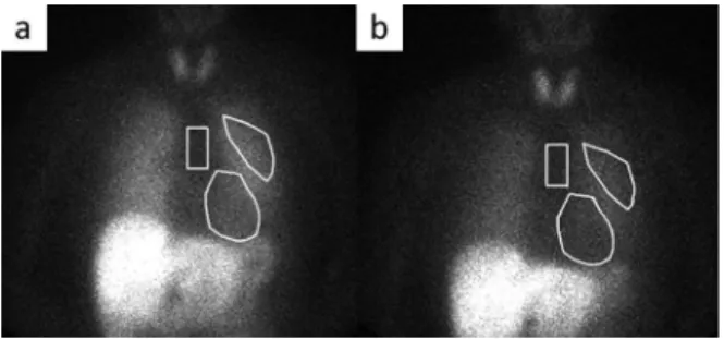 Fig. 1  123 I-MIBG scintigraphy.