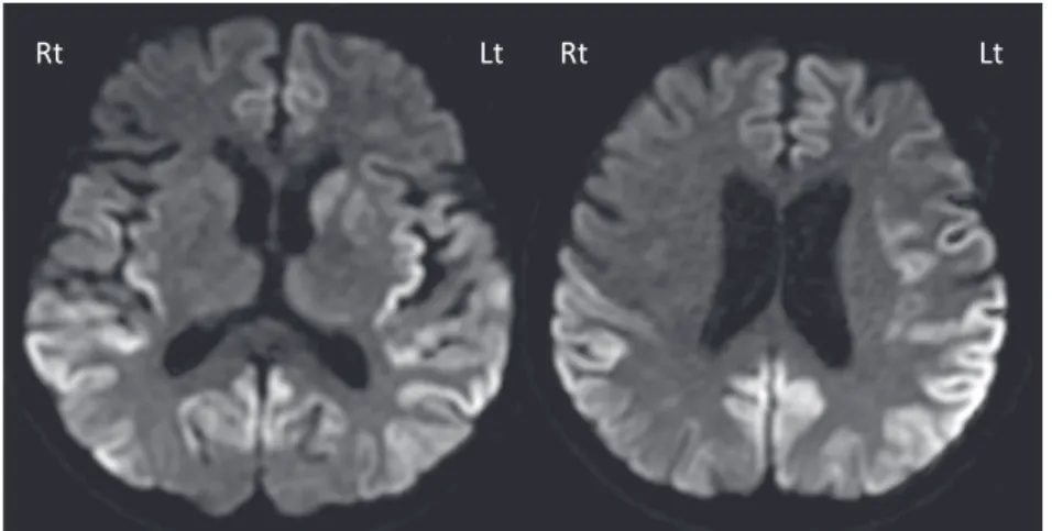 Fig. 1 Brain MR images (diffusion-weighted images).