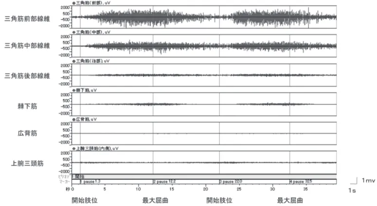 図 3　座位での肩関節屈曲時の肩関節周囲筋の動作筋電図波形 肩関節屈曲角度増加に伴い三角筋の筋活動は漸増するのが確認できた．棘下筋の筋活動は軽度の増加を認めたが，広 背筋の筋活動は認められなかった．動作は緩やかであり，インピンジメントによる疼痛が生じ，スムーズな速度でお こなえなかった．1回の動作に20秒近く要した． 図 4　側臥位での肩関節屈曲時の肩関節周囲筋の動作筋電図波形 動作をとおして三角筋は全線維比較的高い筋活動を呈したが，ほぼ一定していた．棘下筋は軽度増加傾向を認めたが， 広背筋の筋活動は認めら