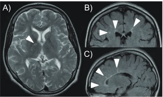 Table 1  Reported cases of multiple sclerosis with uveitis in Japan and current case. Age   (y.o.)  /Sex Age of   onset of  MS (y.o.) Location of  CNS lesions Primary  symptom  of MS Treatment  of MS Age of   onset of  uveitis (y.o.) Location of uveitis Sy