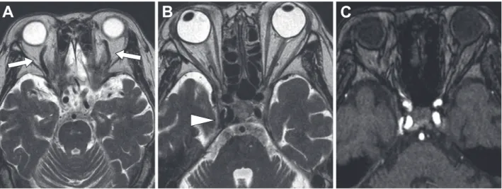 Fig. 3 Cerebral angiogram and transvenous embolization.