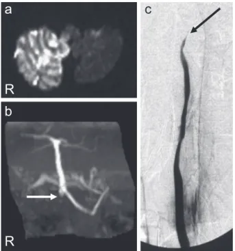 Fig. 2 Case 2: Dissection of the right VA and basilar artery (BA).