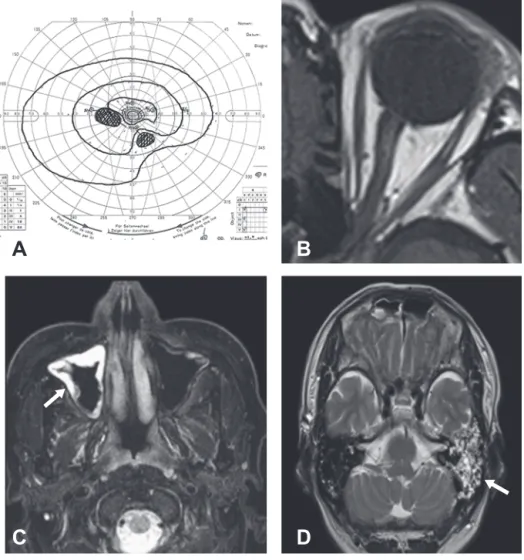 Fig. 1　A) Goldmann visual field test, B–D) MR images.