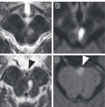 Fig. 2　Brain MRI obtained at the second admission.