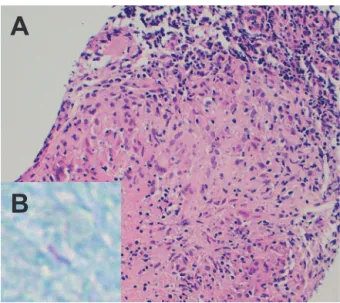 Fig. 3　Coronal sections of brain fluid attenuated inversion recovery  MRI obtained at the first (TR 8,000 ms, TE 117 ms) (A)  and second (TR 8,000 ms, TE 111 ms) (B) admission.
