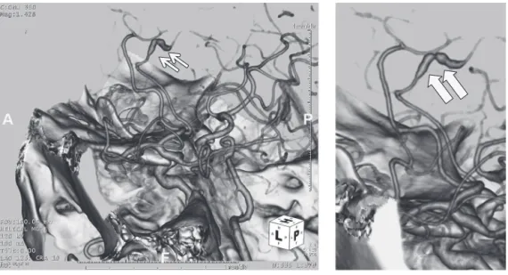 Fig. 5　Intracranial 3D-CT angiography.
