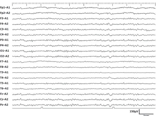 Fig. 2　EEG on the 12th hospital day.