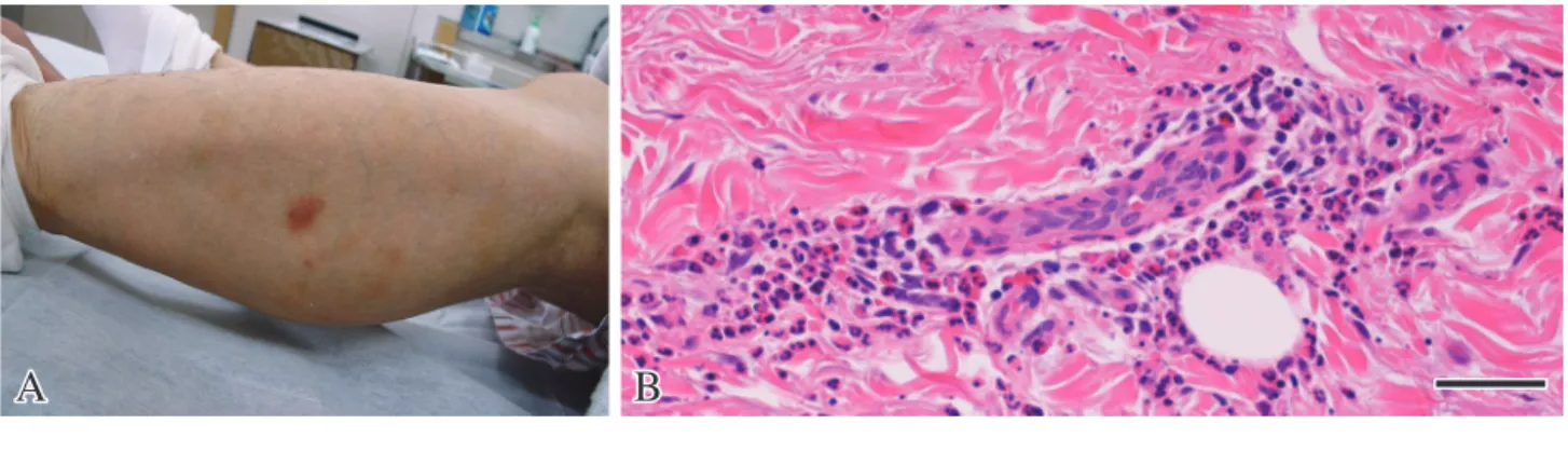 Fig. 1　Purpura.