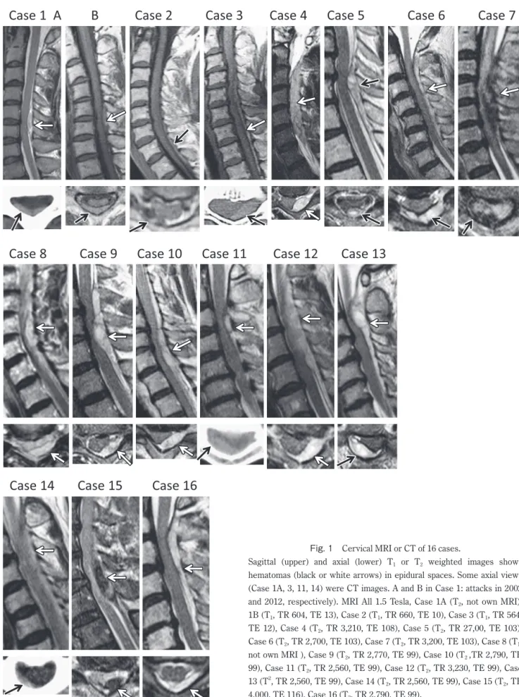 Fig. 1　Cervical MRI or CT of 16 cases.