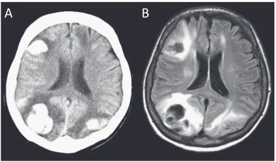 Fig. 2　Brain CT and MRI at 7 days after admission.