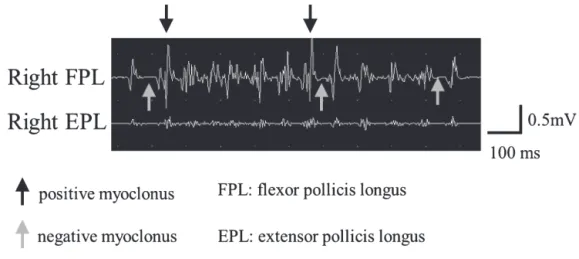 Fig. 3　Surface electromyogram (EMG) of Patient 2 on day 50 (3 days after admission).
