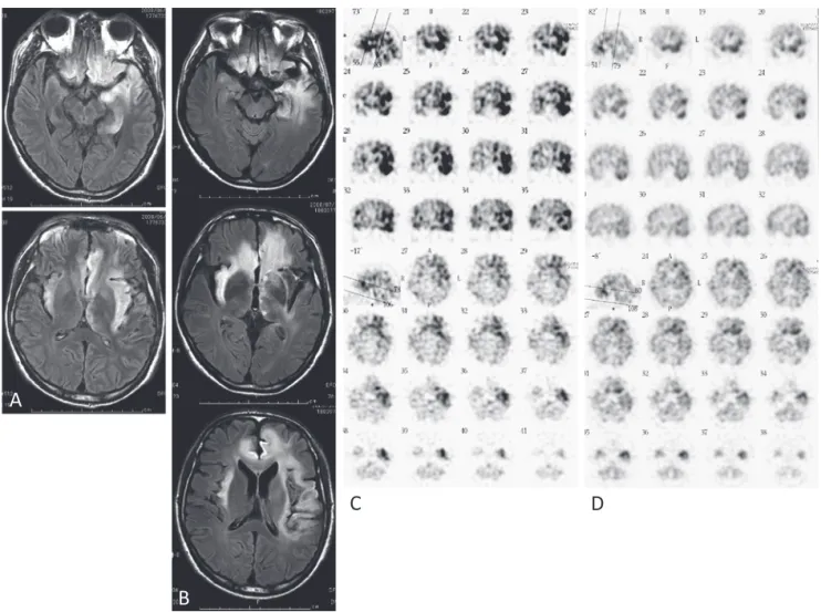 Fig. 1 Serial fluid-attenuated inversion recovery (FLAIR) imaging on days 19, 61 and Single photon emission computed tomography (SPECT)  on days 15 and 50.