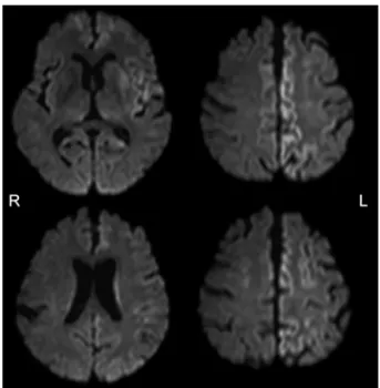 Fig. 2　Diffusion-weighted MRI of the brain.
