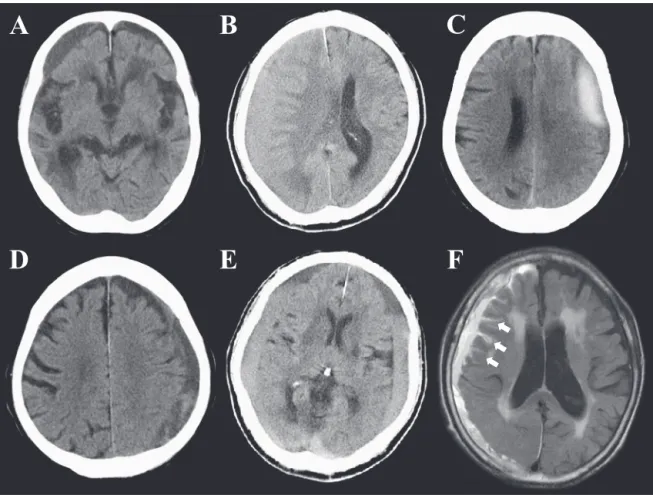 Fig. 1　CT findings demonstrating examples of five types (A–E) and MRI finding (F) of sulcal hyperintensity   of chronic subdural hematoma.
