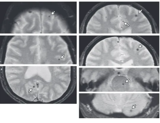 Fig. 4　Brain MRI.
