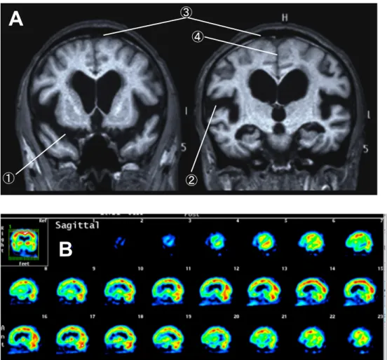 Fig. 2 iNPH 患者の MRI でみとめられる DESH と脳血流 SPECT でみとめられる CAPPAH sign．