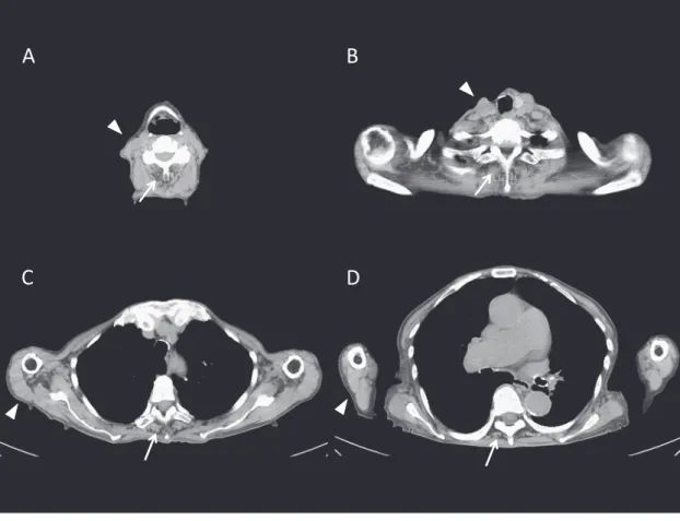 Fig. 1  Computed tomography (CT) of the neck and paraspinal muscles.
