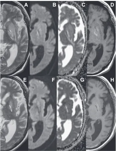 Fig. 2 MRI obtained on 21st (A-D) and 50th (E-H) day after admission.