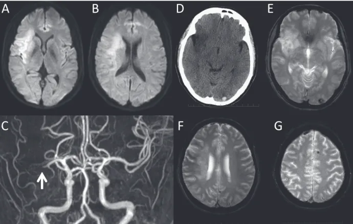 Fig. 1 Head CT and MRI obtained on day 0 (A, B, C), day 2 (D) and day 44 (E, F, G).