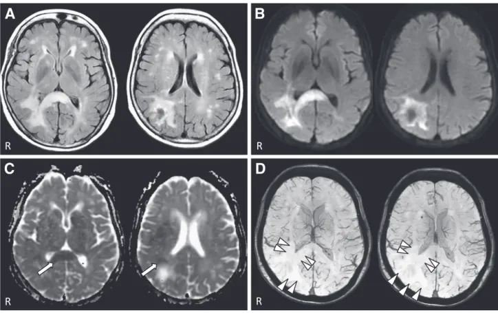 Fig. 1 A, B, C and D show the initial MR study at admission.