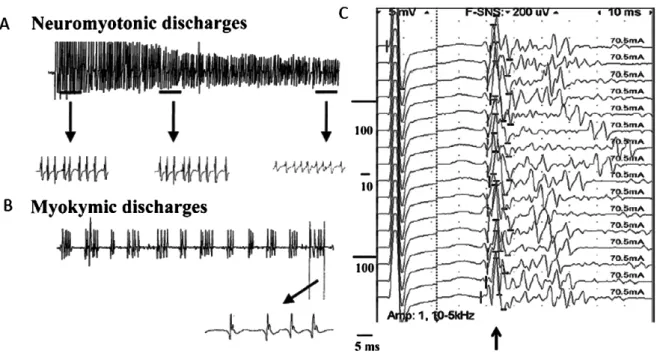 Fig. 1 Isaacs 症候群でみとめられる末梢神経の過剰興奮．