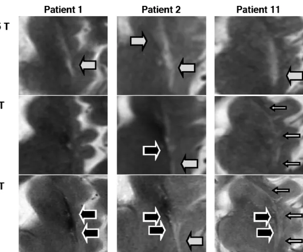 Fig. 1 Putaminal Magnetic Resonance Imaging Features at Various Magnetic Field Strengths in Multiple System Atrophy.
