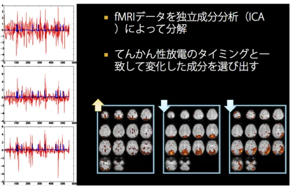 Fig. 1 ICA をもちいて異常放電と fMRI 上の変化を結びつけた自験例．
