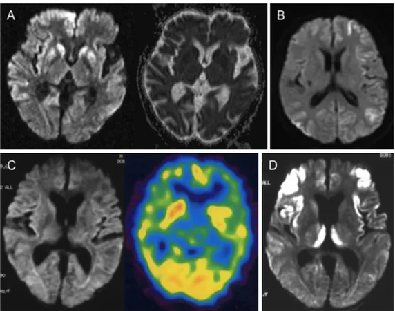 Fig. 1 Neuroimaging of Creutzfeldt-Jakob disease (CJD).